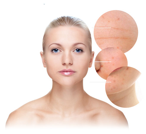 acne clearance