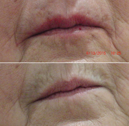 dermal filler results 4