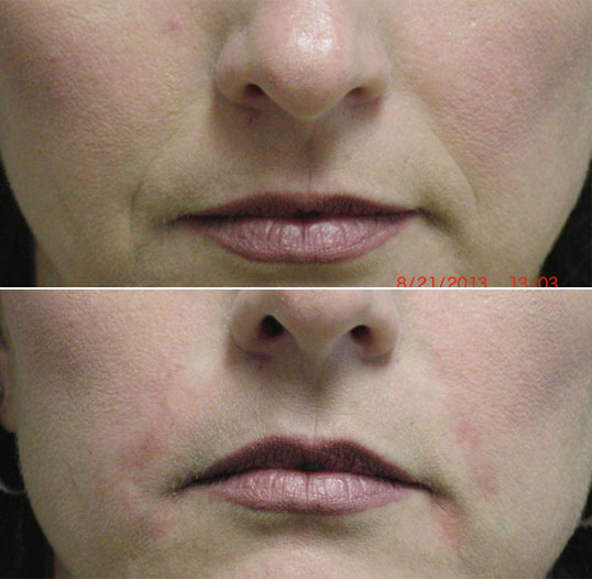 dermal filler results 6